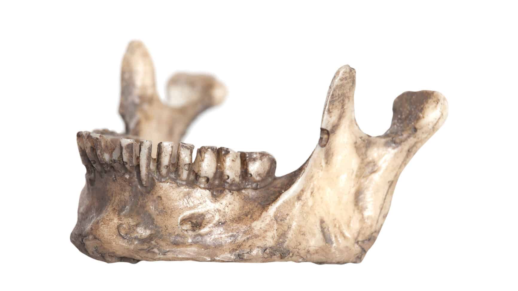 Dental Plaque