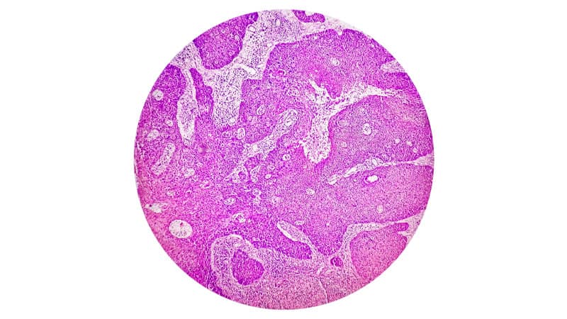 oral-cancer